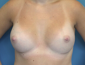 Breast Implant After